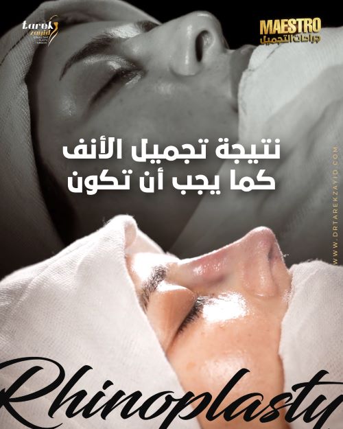 مراحل تغير الأنف بعد عملية التجميل